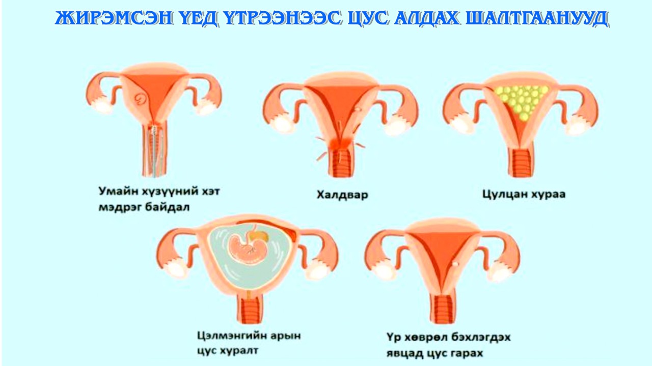 ЖИРЭМСНИЙ ЭРТ ХУГАЦААНД ЯАГААД ҮТРЭЭНЭЭС ЦУС ГАРДАГ ВЭ? /НӨАГ-ын Эх барих эмэгтэйчүүдийн эмч У.Халиун/
