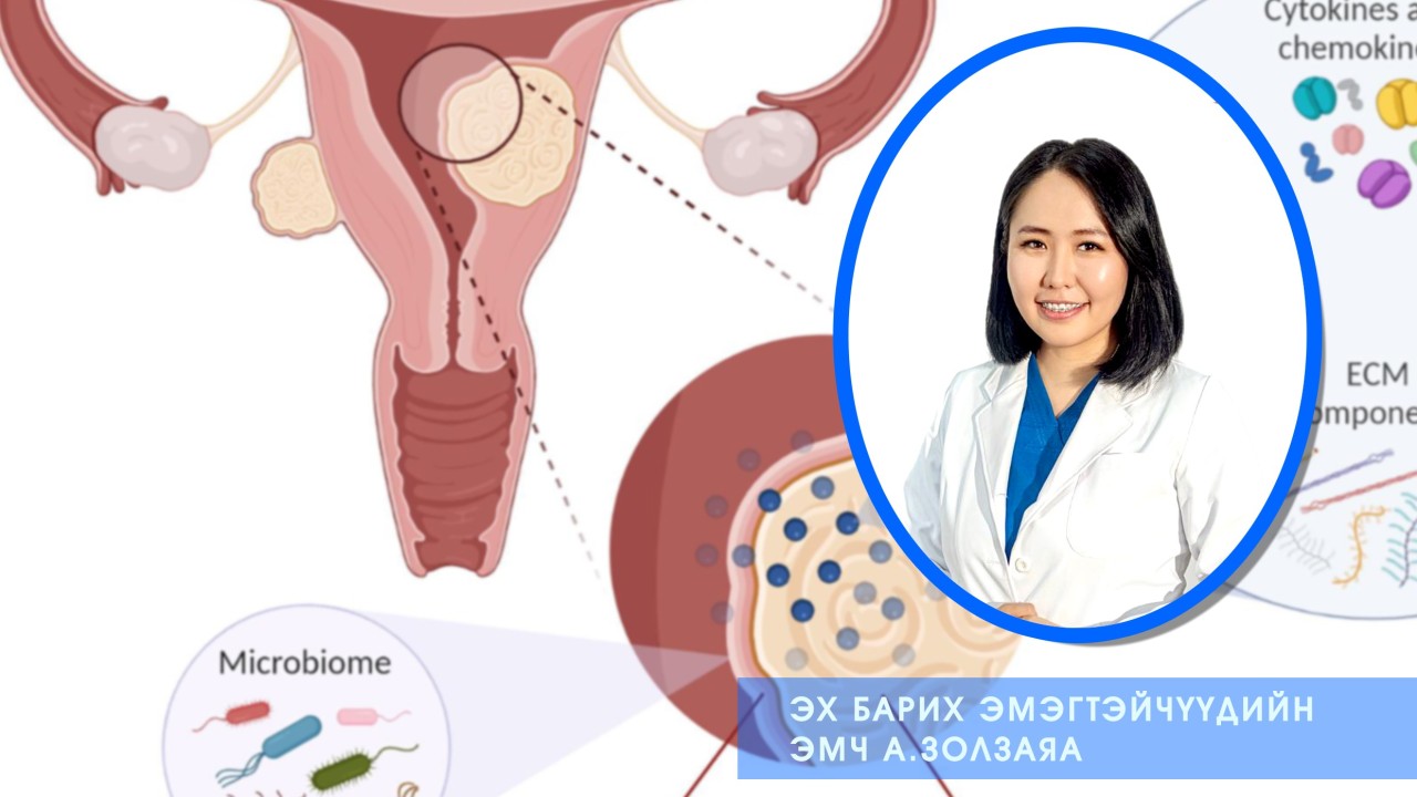 Умайн булчингийн хоргүй хавдар. Эмч А.Золзаяа